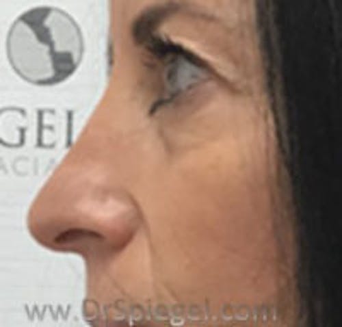 Non-Surgical Rhinoplasty / Nose Filler Before & After Gallery - Patient 232034 - Image 4