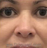 Non-Surgical Rhinoplasty / Nose Filler Before & After Gallery - Patient 400454 - Image 1