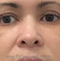 Non-Surgical Rhinoplasty / Nose Filler Before & After Gallery - Patient 400454 - Image 2