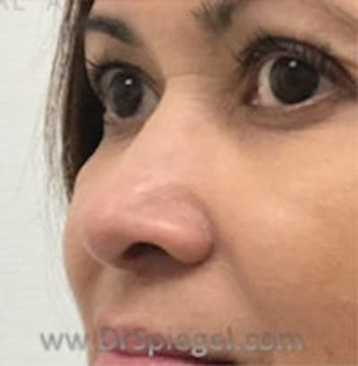 Non-Surgical Rhinoplasty / Nose Filler Before & After Gallery - Patient 400454 - Image 3