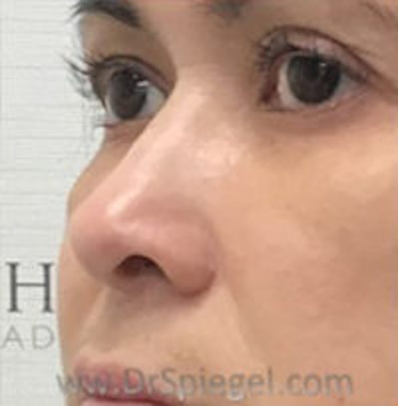 Non-Surgical Rhinoplasty / Nose Filler Before & After Gallery - Patient 400454 - Image 4