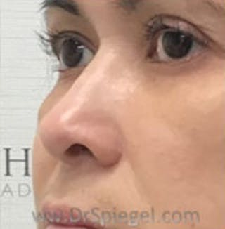 Non-Surgical Rhinoplasty / Nose Filler Before & After Gallery - Patient 400454 - Image 4