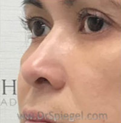 Non-Surgical Rhinoplasty / Nose Filler Before & After Gallery - Patient 400454 - Image 4