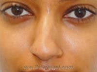 Non-Surgical Rhinoplasty / Nose Filler Before & After Gallery - Patient 279960 - Image 1