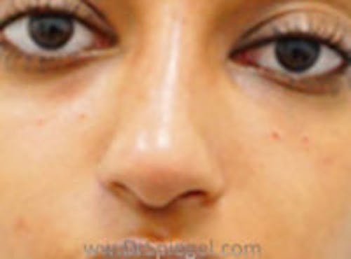 Non-Surgical Rhinoplasty / Nose Filler Before & After Gallery - Patient 279960 - Image 2
