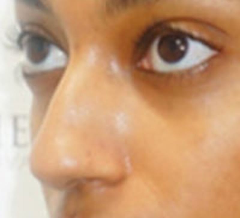 Non-Surgical Rhinoplasty / Nose Filler Before & After Gallery - Patient 279960 - Image 3