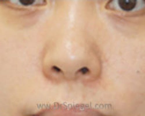 Non-Surgical Rhinoplasty Before & After Gallery - Patient 327591 - Image 1