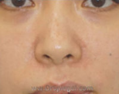 Non-Surgical Rhinoplasty Before & After Gallery - Patient 327591 - Image 2