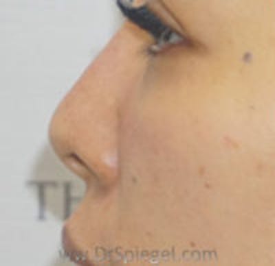 Non-Surgical Rhinoplasty Before & After Gallery - Patient 327591 - Image 4