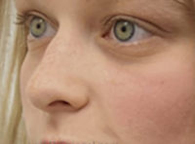 Non-Surgical Rhinoplasty / Nose Filler Before & After Gallery - Patient 145814 - Image 1