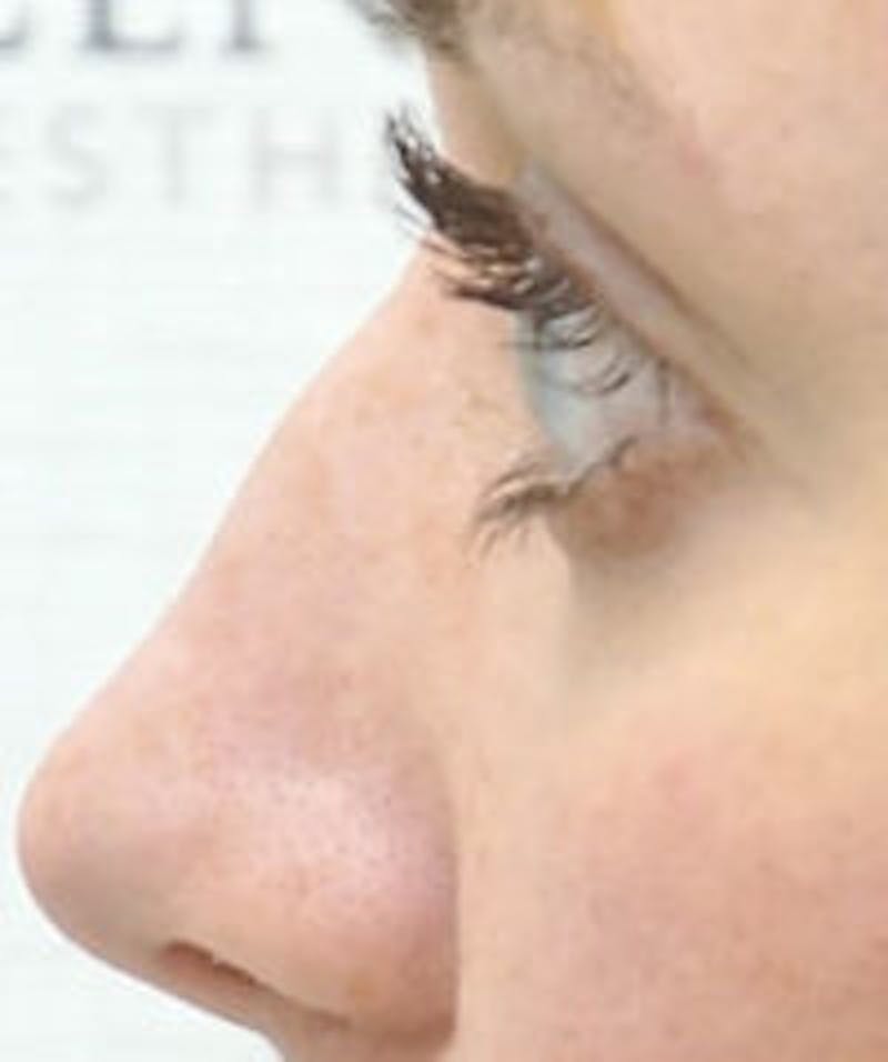 Non-Surgical Rhinoplasty / Nose Filler Before & After Gallery - Patient 177239 - Image 1