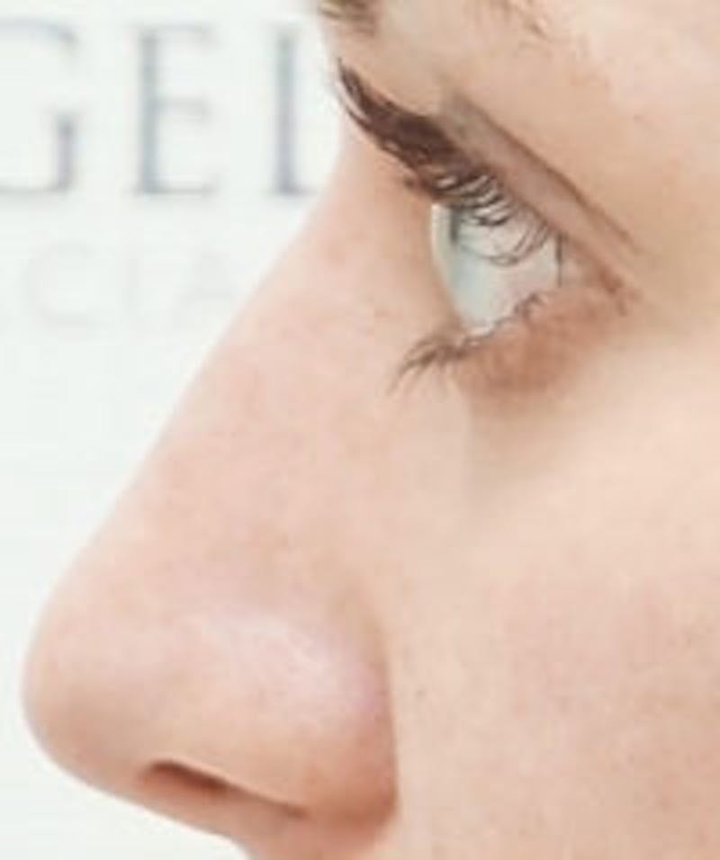 Non-Surgical Rhinoplasty / Nose Filler Before & After Gallery - Patient 177239 - Image 2