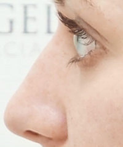 Non-Surgical Rhinoplasty / Nose Filler Before & After Gallery - Patient 177239 - Image 2