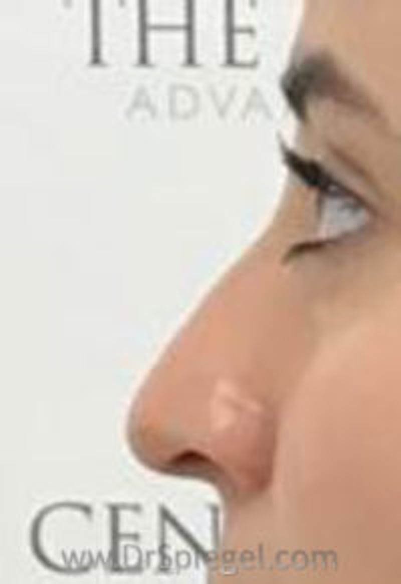 Non-Surgical Rhinoplasty / Nose Filler Before & After Gallery - Patient 211687 - Image 1