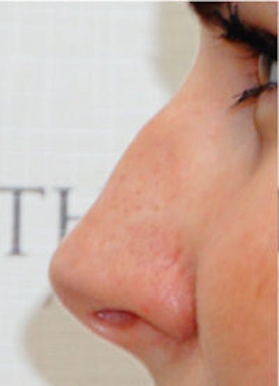 Non-Surgical Rhinoplasty / Nose Filler Before & After Gallery - Patient 184428 - Image 1