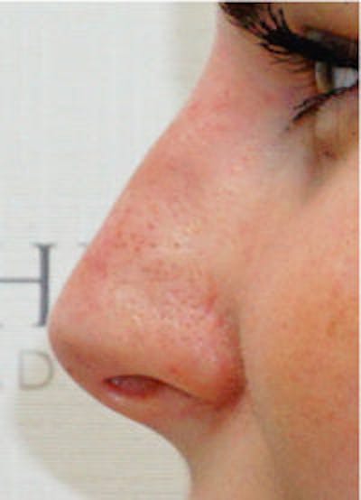 Non-Surgical Rhinoplasty / Nose Filler Before & After Gallery - Patient 184428 - Image 2