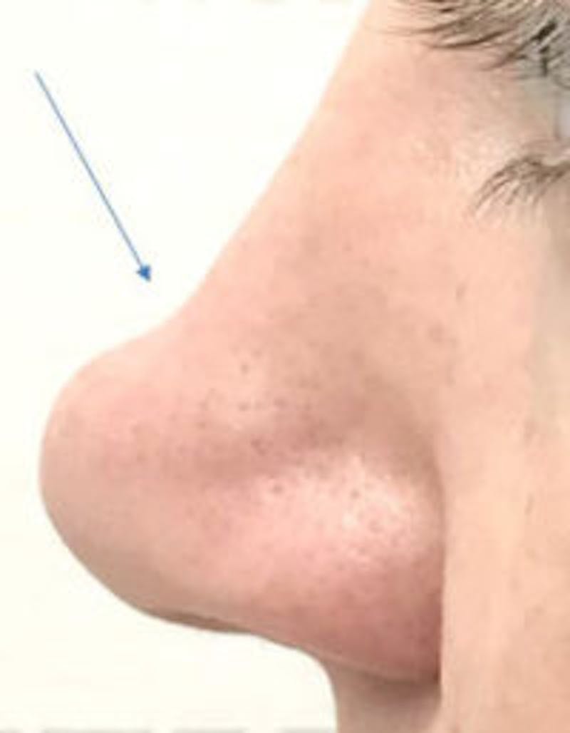 Non-Surgical Rhinoplasty / Nose Filler Before & After Gallery - Patient 390363 - Image 1