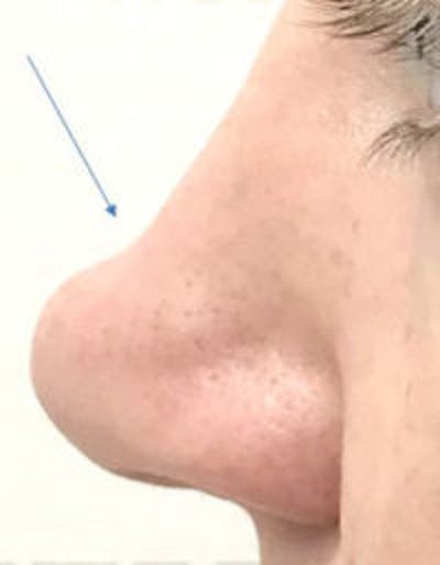 Non-Surgical Rhinoplasty / Nose Filler Before & After Gallery - Patient 390363 - Image 1