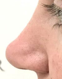 Non-Surgical Rhinoplasty / Nose Filler Before & After Gallery - Patient 390363 - Image 2