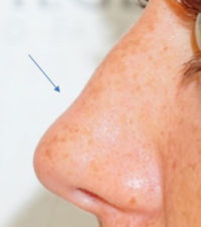 Non-Surgical Rhinoplasty / Nose Filler Before & After Gallery - Patient 239916 - Image 1