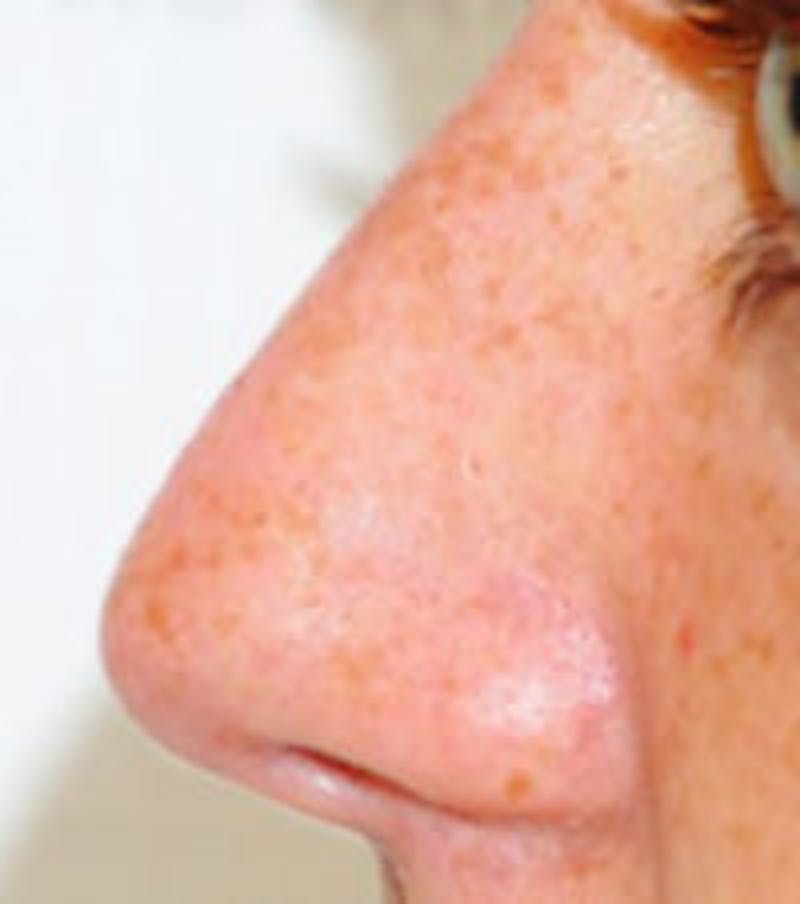 Non-Surgical Rhinoplasty / Nose Filler Before & After Gallery - Patient 239916 - Image 2