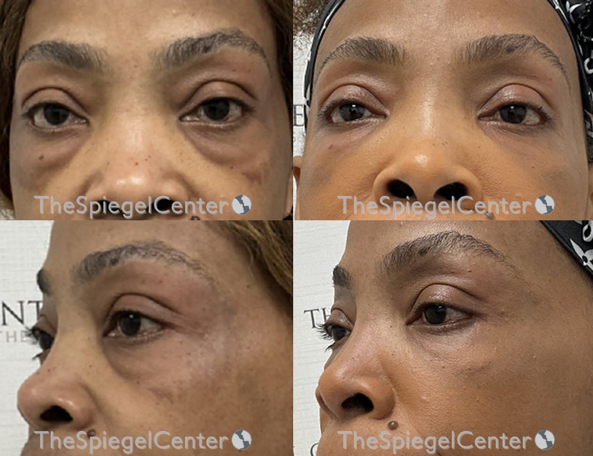 Tear Trough / Under Eye Fillers Before & After Gallery - Patient 419586 - Image 1