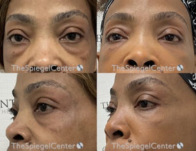 Tear Trough / Under Eye Fillers Before & After Gallery - Patient 419586 - Image 1