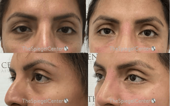 Tear Trough / Under Eye Fillers Before & After Gallery - Patient 313612 - Image 1