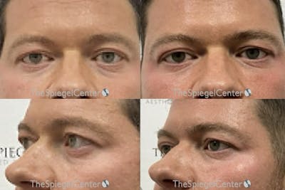 Tear Trough / Under Eye Fillers Before & After Gallery - Patient 374470 - Image 1