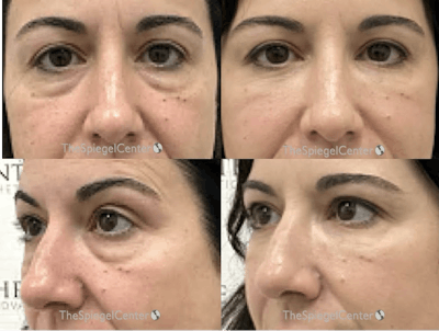 Tear Trough / Under Eye Fillers Before & After Gallery - Patient 210167 - Image 1