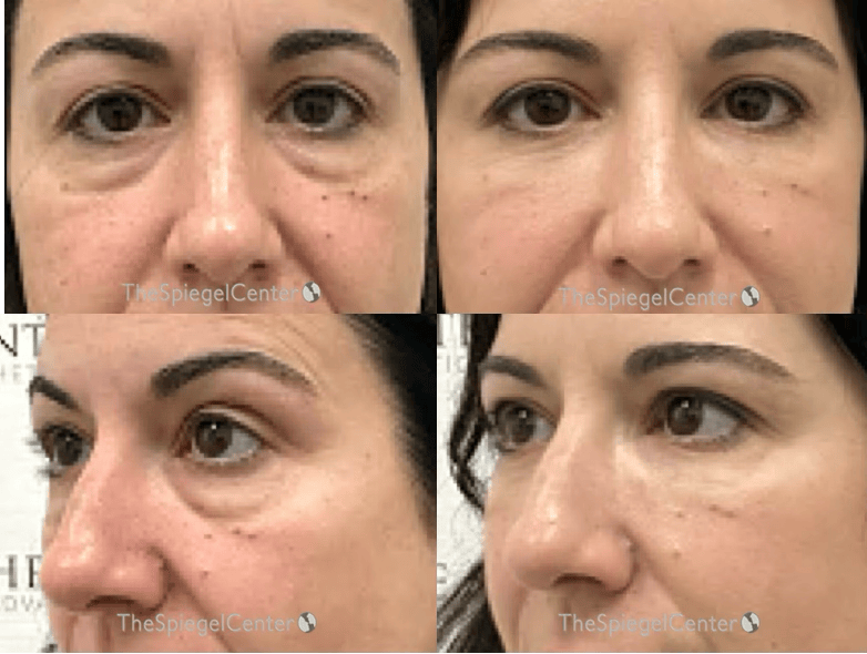 Tear Trough / Under Eye Fillers Before & After Gallery - Patient 210167 - Image 1