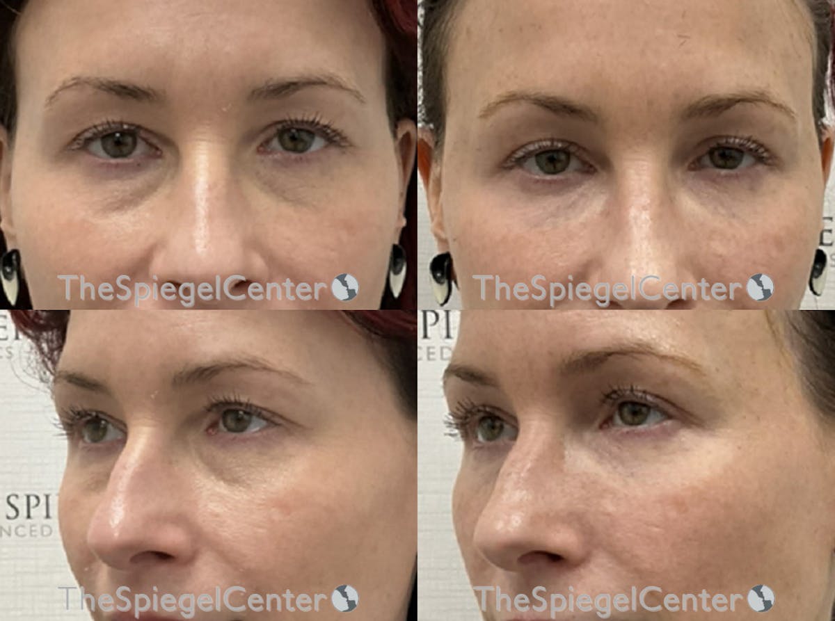 Tear Trough / Under Eye Fillers Before & After Gallery - Patient 196971 - Image 1