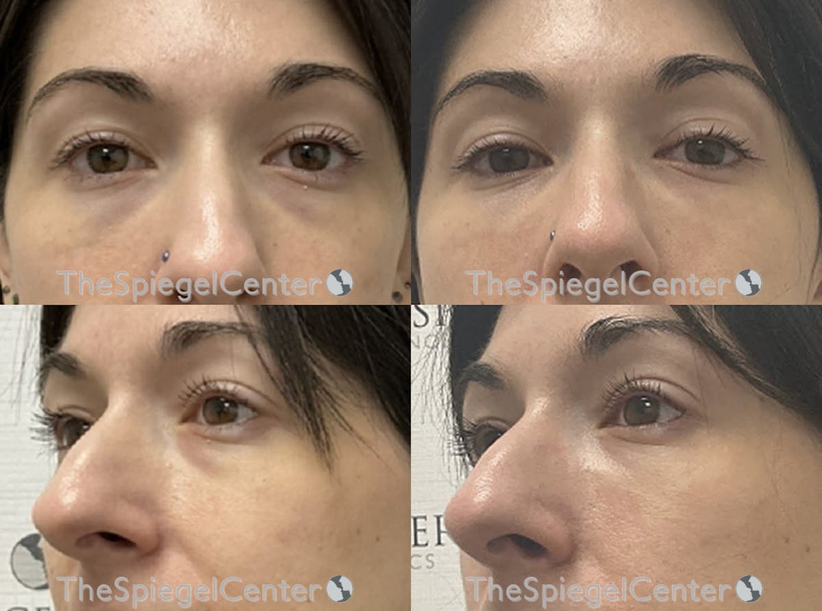 Tear Trough / Under Eye Fillers Before & After Gallery - Patient 303376 - Image 1