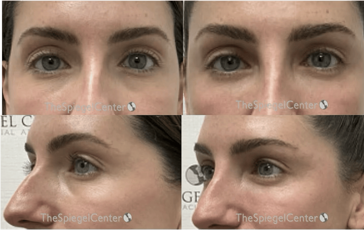 Tear Trough / Under Eye Fillers Before & After Gallery - Patient 188706 - Image 1