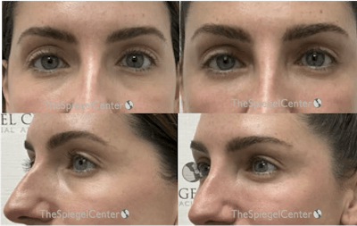 Tear Trough / Under Eye Fillers Before & After Gallery - Patient 188706 - Image 1