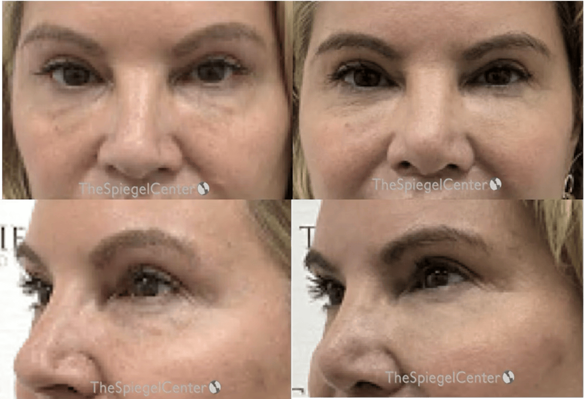 Tear Trough / Under Eye Fillers Before & After Gallery - Patient 140439 - Image 1