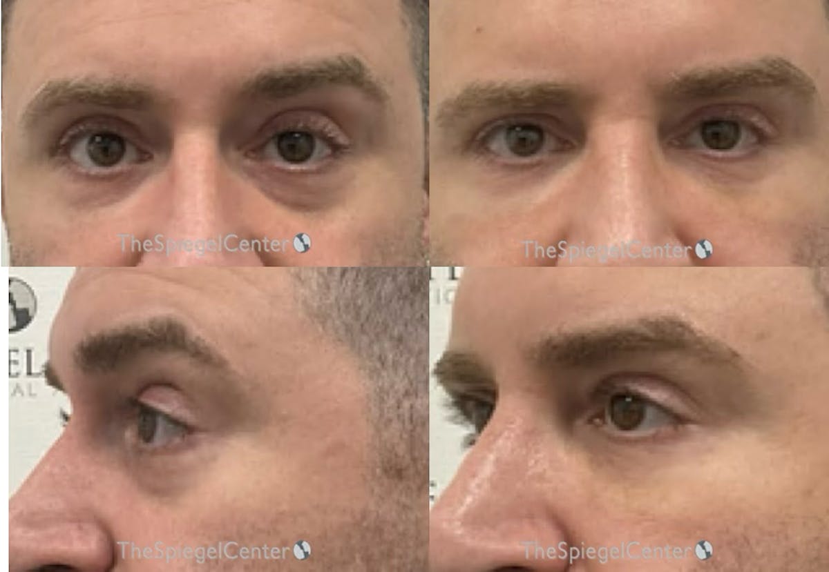 Tear Trough / Under Eye Fillers Before & After Gallery - Patient 413952 - Image 1