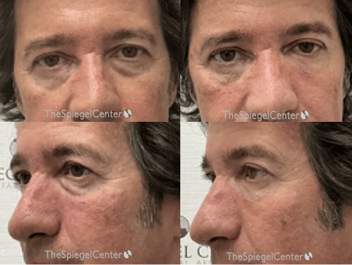 Tear Trough / Under Eye Fillers Before & After Gallery - Patient 338969 - Image 1