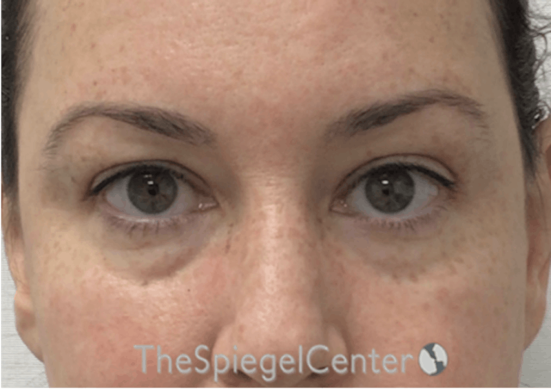 Tear Trough / Under Eye Fillers Before & After Gallery - Patient 104163 - Image 1