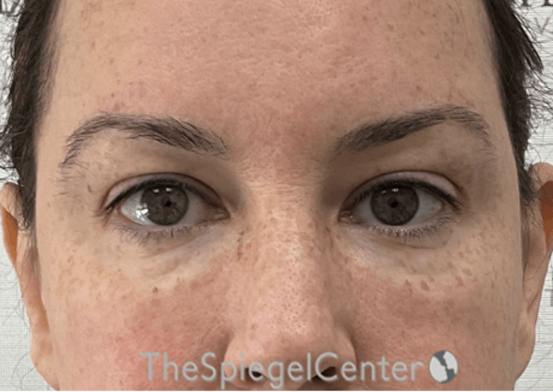 Tear Trough / Under Eye Fillers Before & After Gallery - Patient 104163 - Image 2