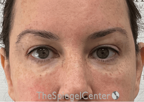Tear Trough / Under Eye Fillers Before & After Gallery - Patient 104163 - Image 2