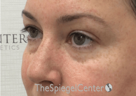 Tear Trough / Under Eye Fillers Before & After Gallery - Patient 104163 - Image 3