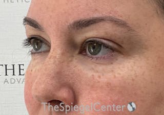 Tear Trough / Under Eye Fillers Before & After Gallery - Patient 104163 - Image 4