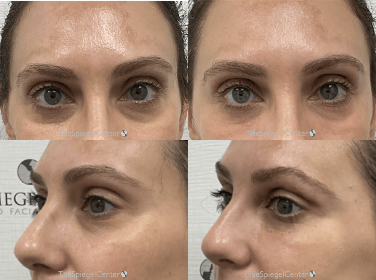 Tear Trough / Under Eye Fillers Before & After Gallery - Patient 254845 - Image 1