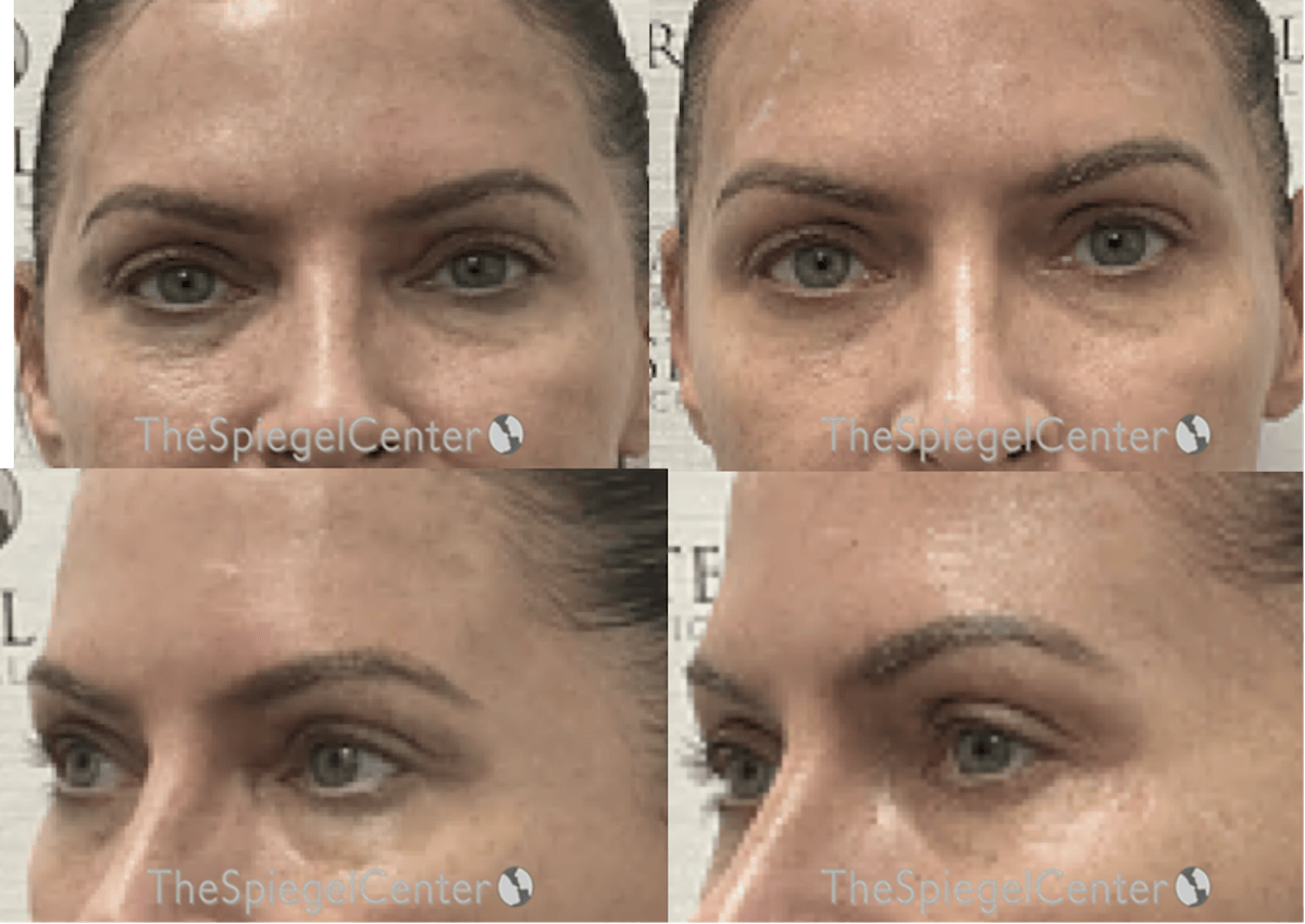 Tear Trough / Under Eye Fillers Before & After Gallery - Patient 159366 - Image 1