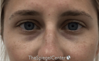 Tear Trough / Under Eye Fillers Before & After Gallery - Patient 383715 - Image 1