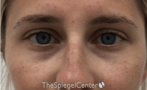 Tear Trough / Under Eye Fillers Before & After Gallery - Patient 383715 - Image 1