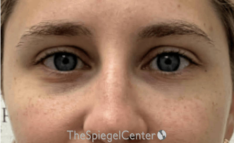 Tear Trough / Under Eye Fillers Before & After Gallery - Patient 383715 - Image 2