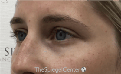 Tear Trough / Under Eye Fillers Before & After Gallery - Patient 383715 - Image 3