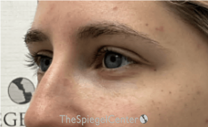 Tear Trough / Under Eye Fillers Before & After Gallery - Patient 383715 - Image 4